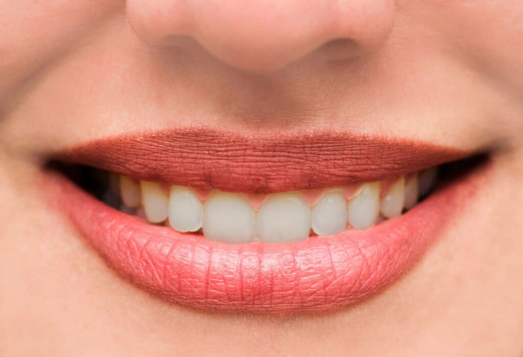 How many veneers are needed shown on a close-up smile