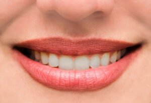 How many veneers are needed shown on a close-up smile